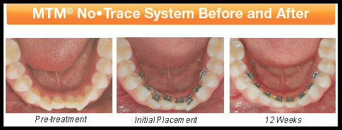 MTM No Trace System before and after photos of the front teeth