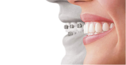 Side view of a smile wearing a clear aligner
