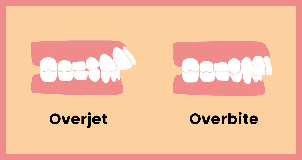 Illustration comparing an overjet and an overbite