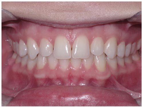 Example front view photo of the teeth for an online smile assessment