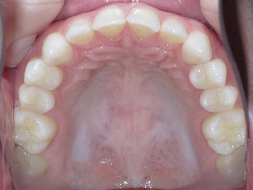 Example photo of the upper teeth for an online smile assessment