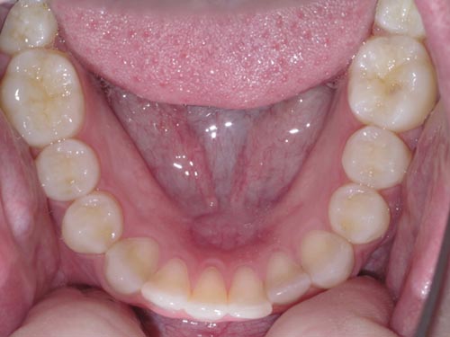 Example photo of the lower teeth for an online smile assessment