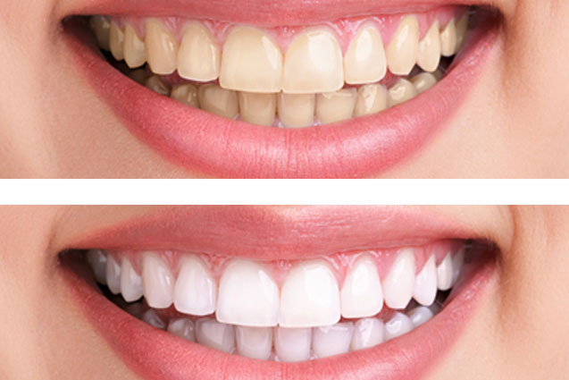 Before and after teeth whitening comparison showing yellowed teeth and a brighter white smile