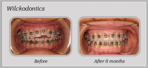 Wilckodontics before and after 6 months photos of teeth with braces