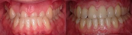 Before and after photos of crowded front teeth straightened with fast braces