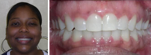 Woman's portrait next to a close-up of her smile after jaw surgery