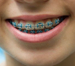 Close-up of a smile with metal braces and blue elastic ties