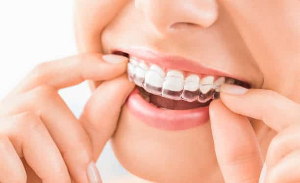 Woman fitting a clear aligner onto her teeth