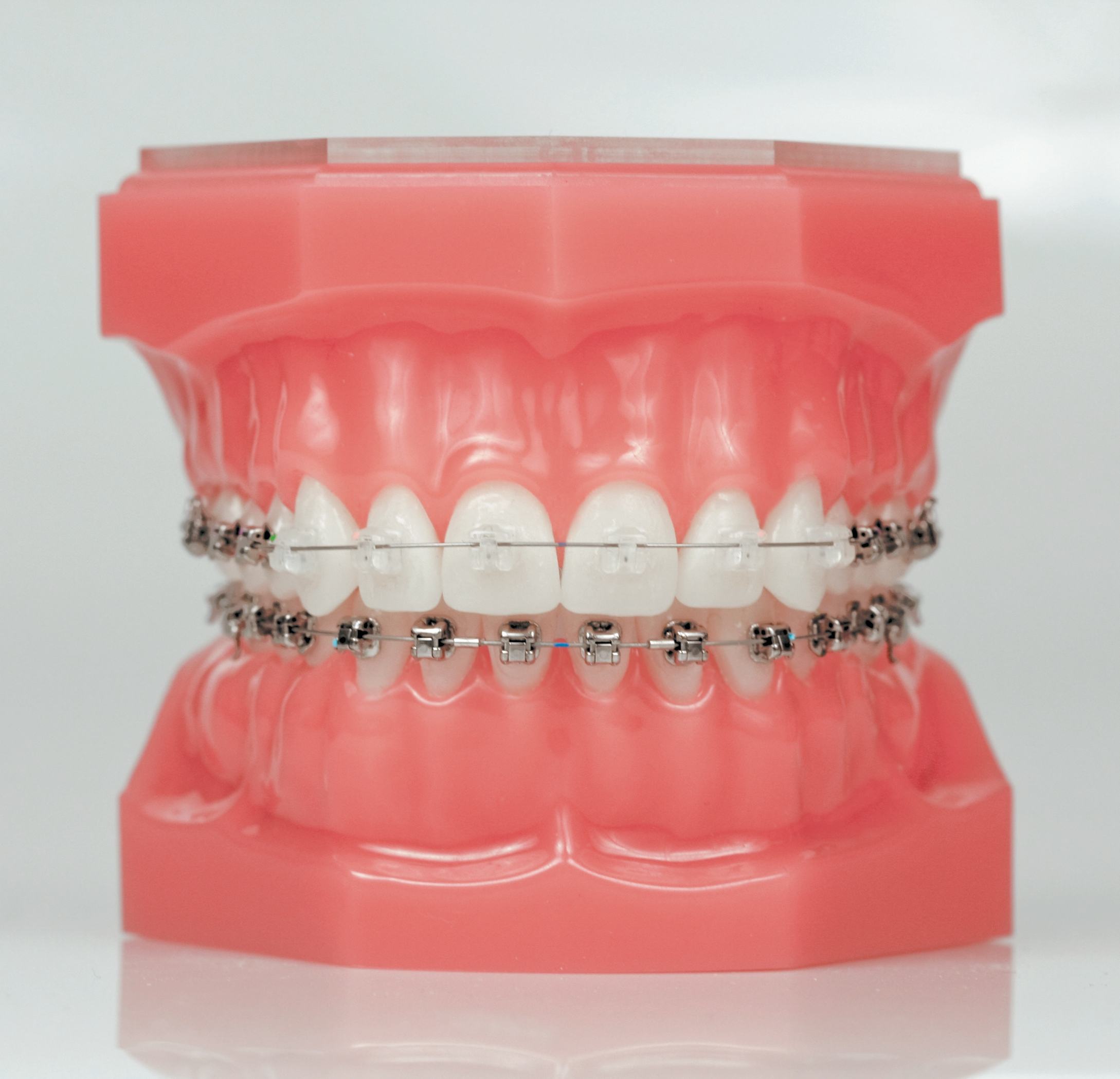 Dental model with clear upper braces and metal lower braces