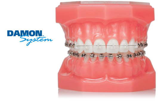 Damon System self-ligating braces shown on a dental model