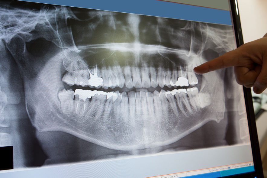 Finger pointing to a panoramic dental X-ray on a screen