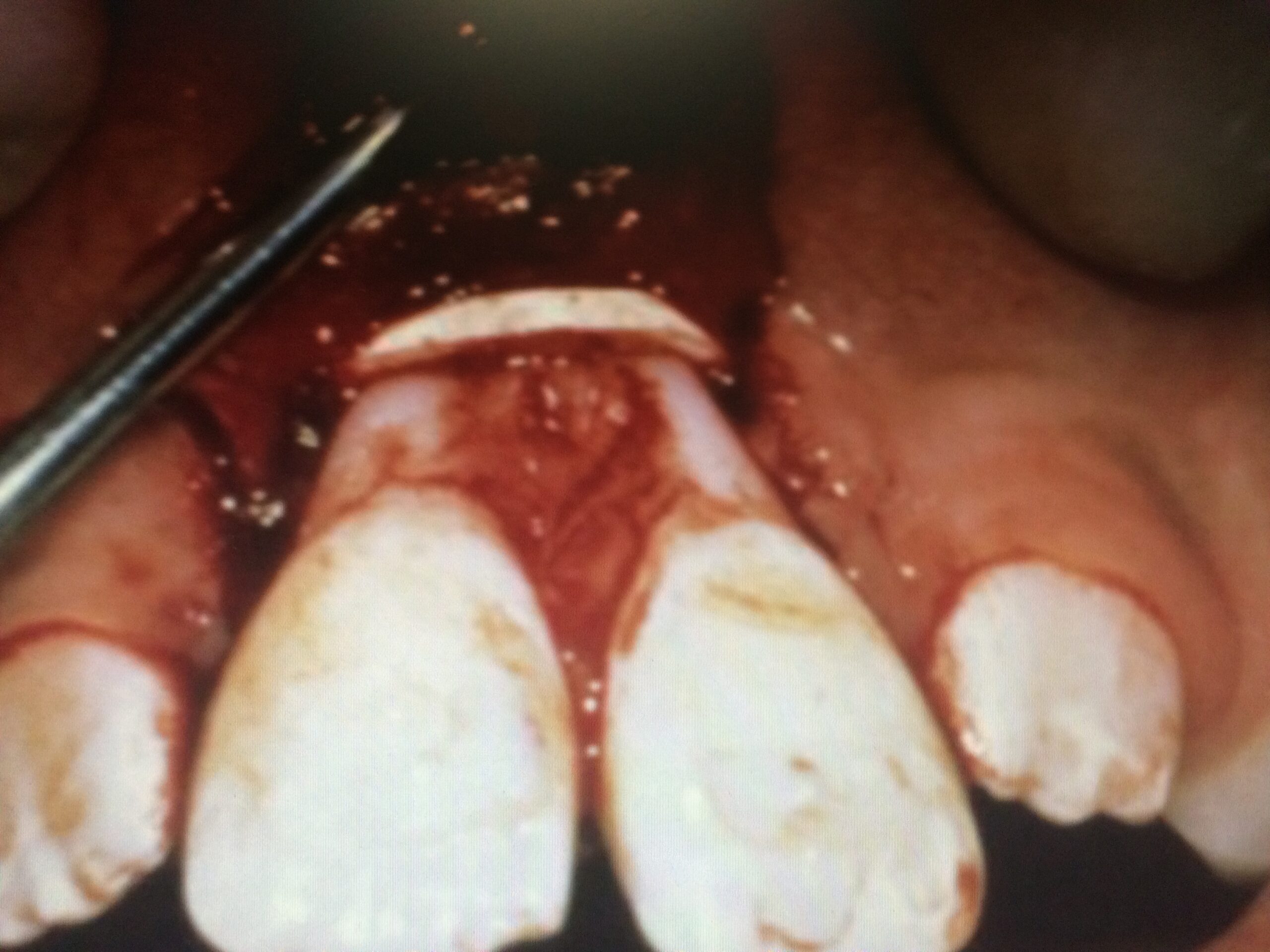 Close-up of front teeth damaged by DIY braces