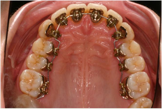 Incognito hidden braces bonded to the back of the upper teeth