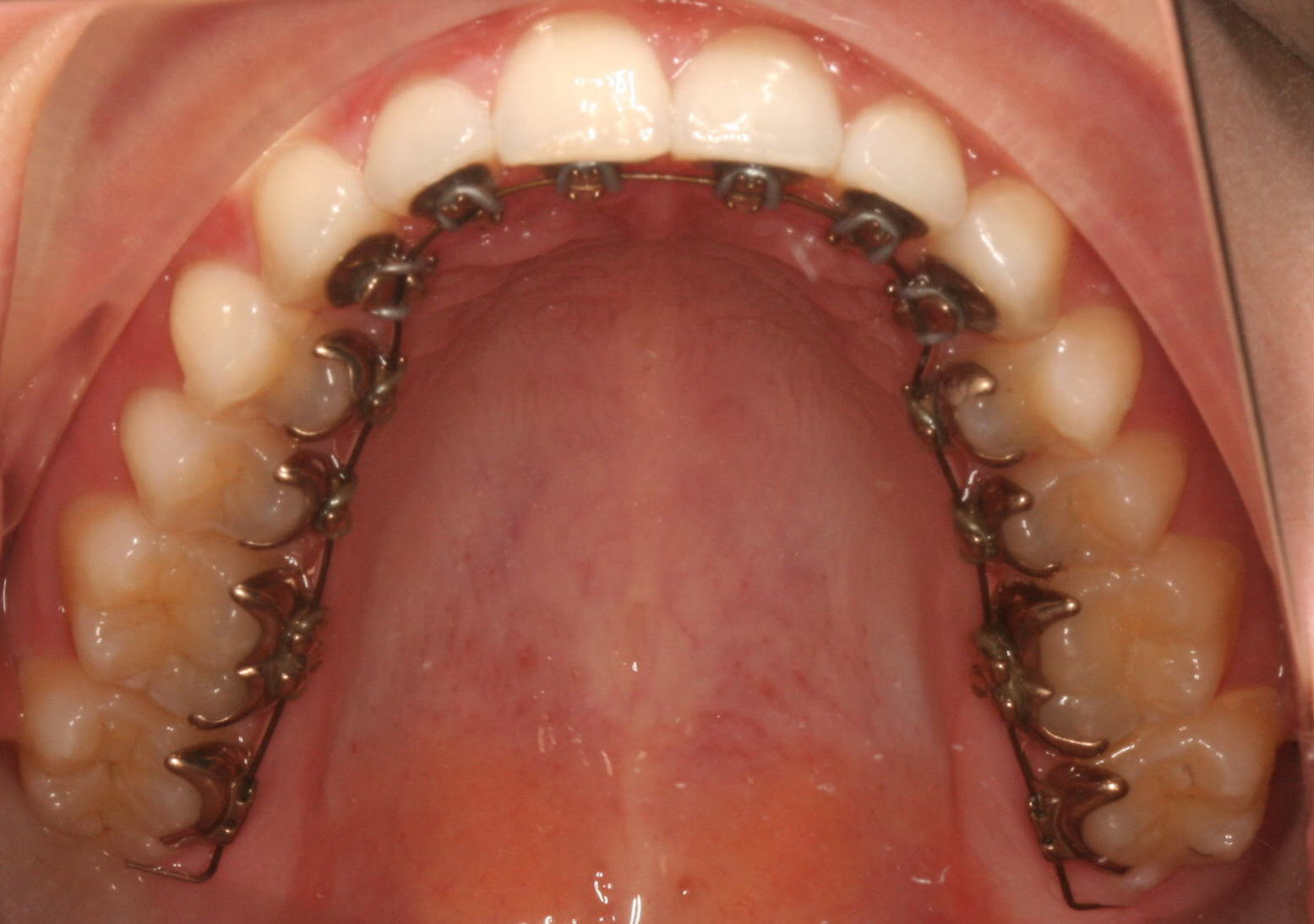 Lingual braces bonded to the back of the lower teeth