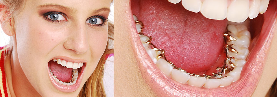 Smiling woman next to a close-up of Incognito braces on the back of the teeth
