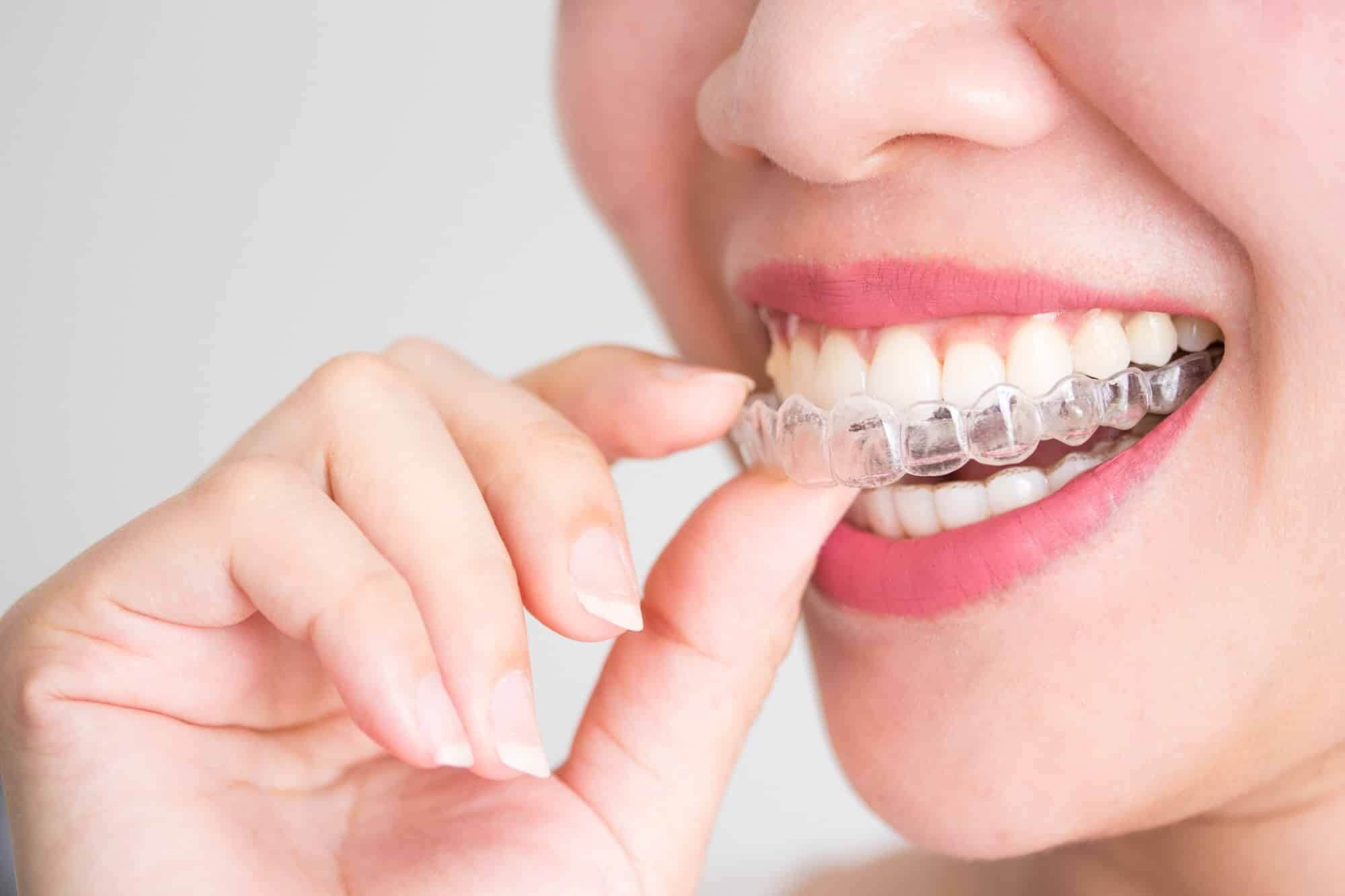 Woman placing a clear Invisalign aligner on her teeth