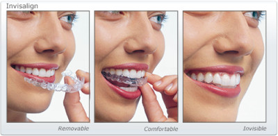 Three photos showing Invisalign aligners being worn and handled