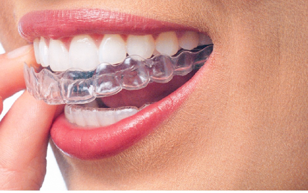 Close-up of a clear aligner being placed on the upper teeth