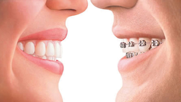 Side-by-side smiles comparing a clear aligner and metal braces