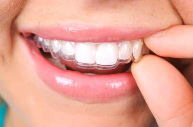 Hand placing a clear aligner onto the upper teeth