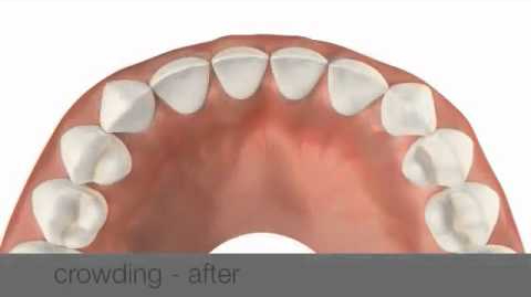 Illustration of a lower dental arch after crowding correction