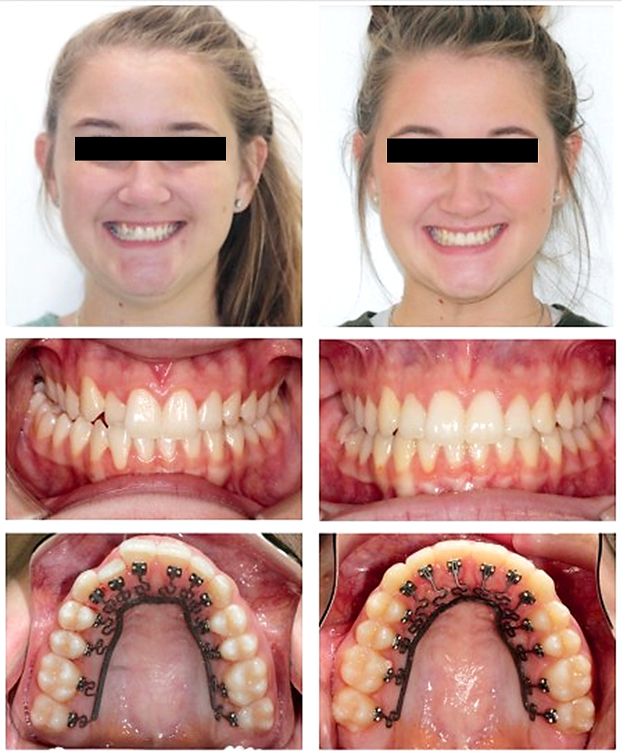 BRIUS before and after photos of the smile and teeth