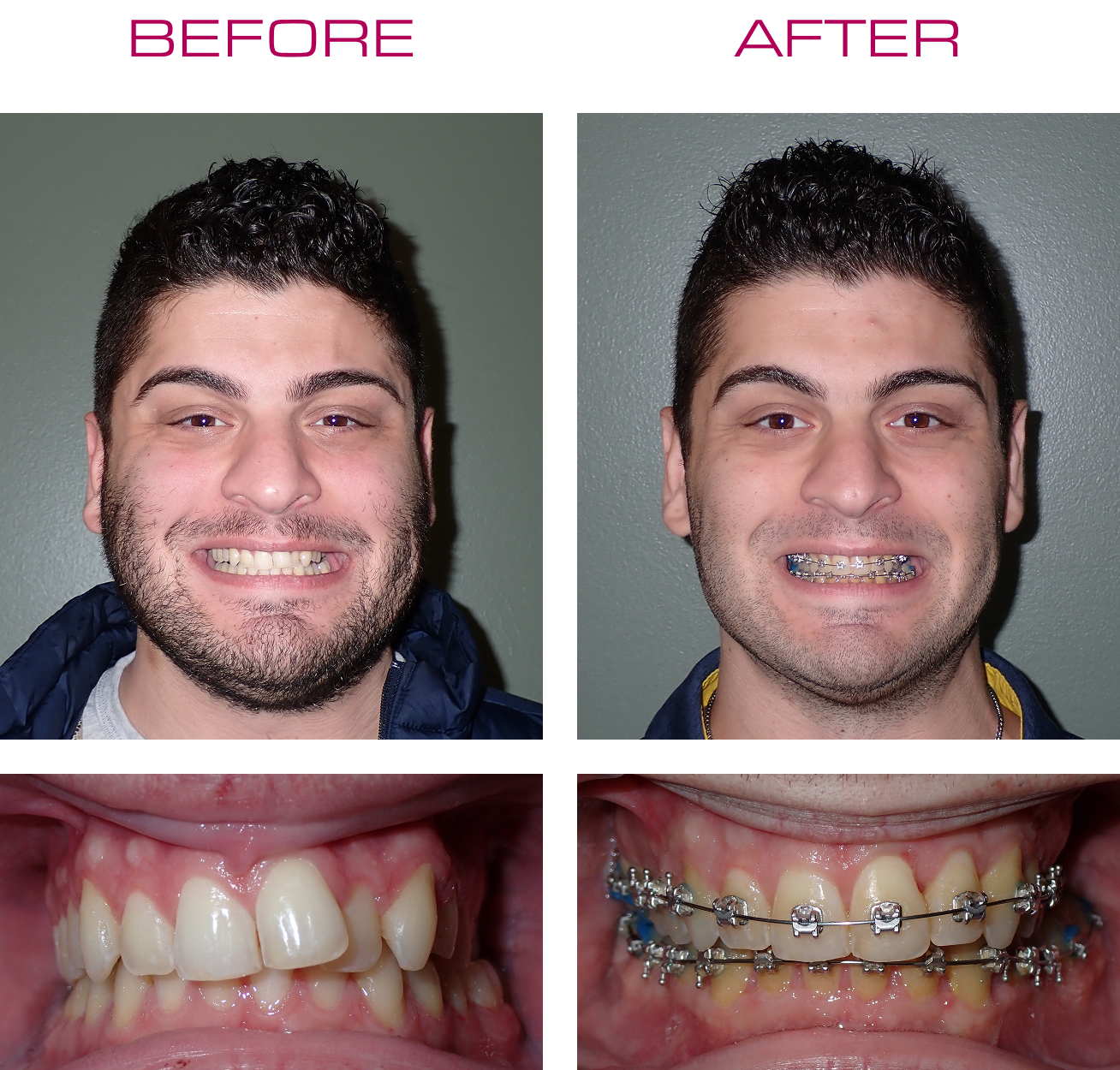 Before and after photos of a man's smile during accelerated orthodontic treatment