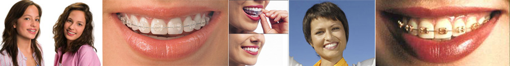 Row of smiles showing different types of braces